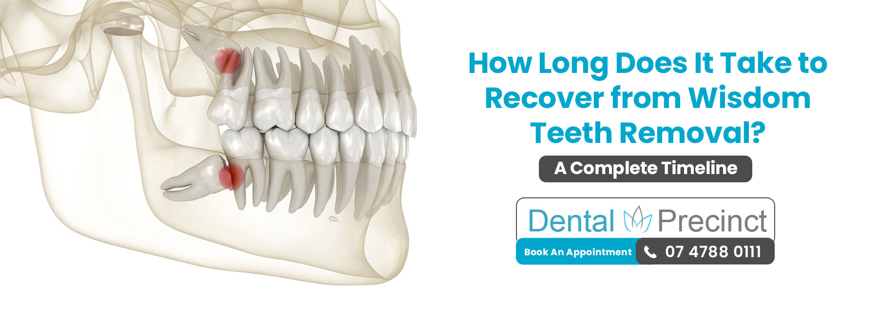How Long Does It Take to Recover from Wisdom Teeth Removal How Long Does It Take to Recover from Wisdom Teeth Removal