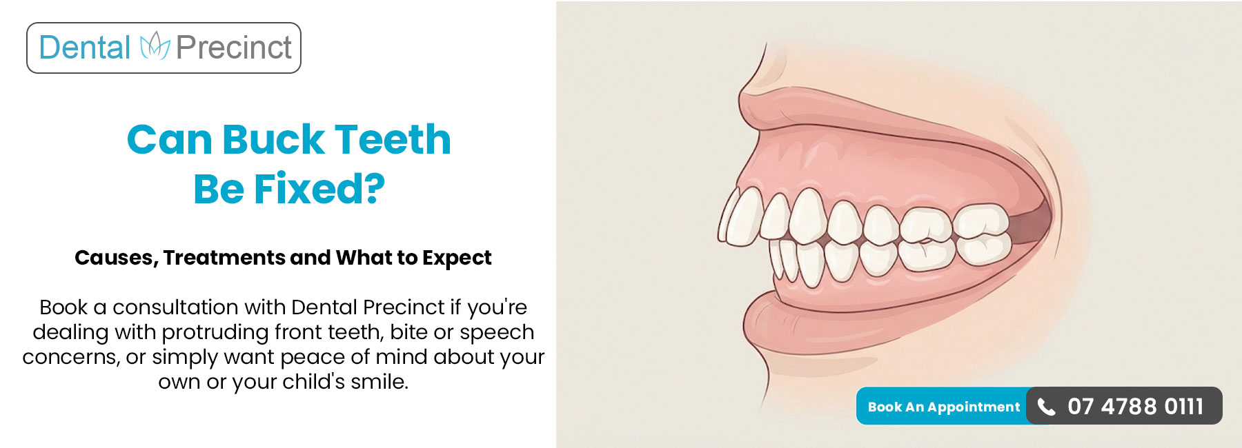 How to Fix Buck Teeth: Overjet Causes, Risks, and Treatment Options